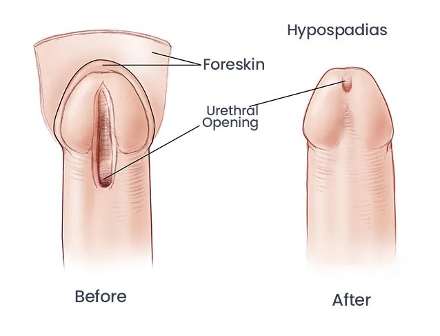 Hypospadias Repair in Nairobi: Facts You Must Know 1 hypospadias repair in Nairobi
